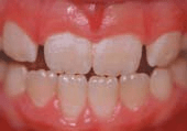 Teeth showing tooth decay