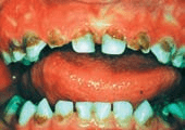 Teeth showing tooth decay
