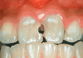 Teeth showing tooth decay